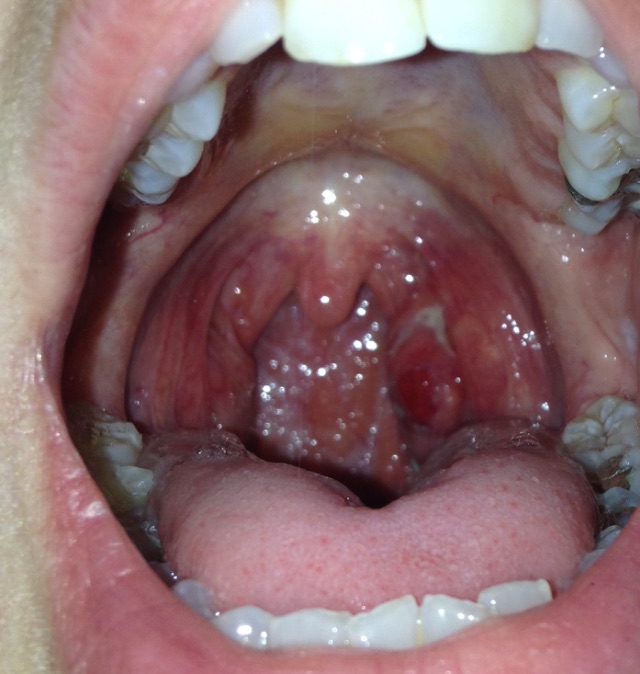 White patches on tongue and throat